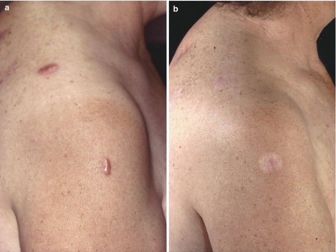 Before and After Cryotherapy