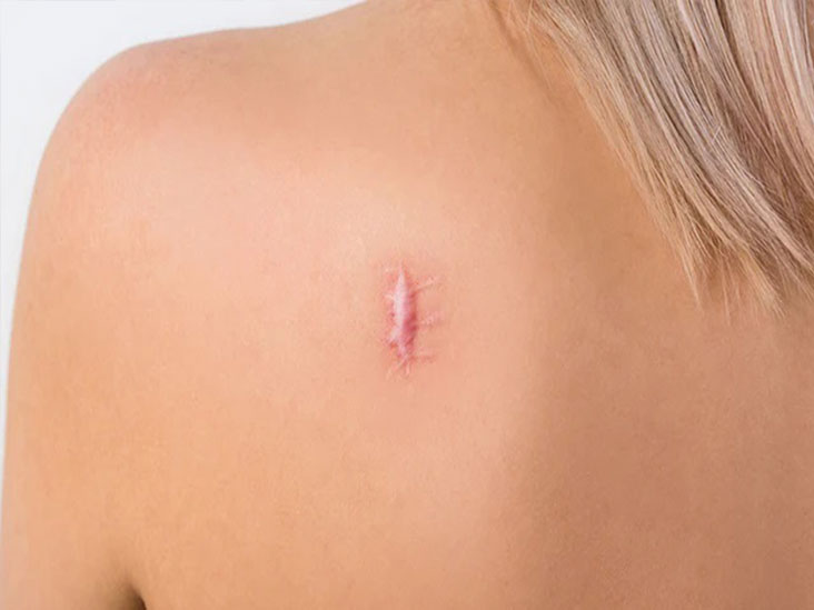 Cryo Treatment for Scars