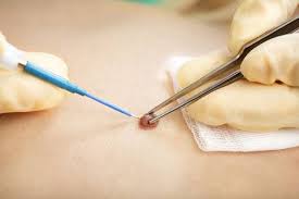 Healing After Electrocautery