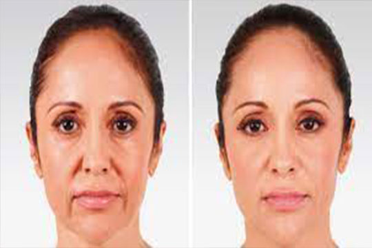 Jawline Contouring with Fillers