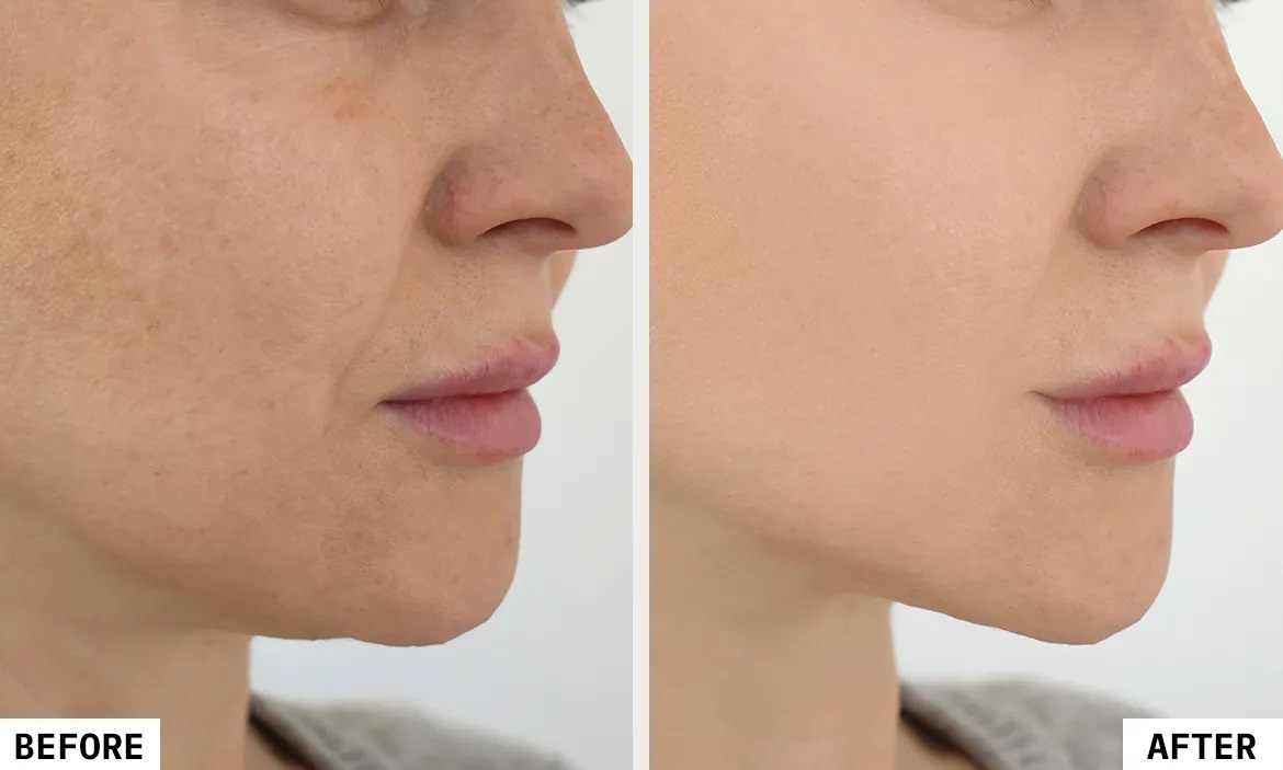 HIFU Treatment in Progress