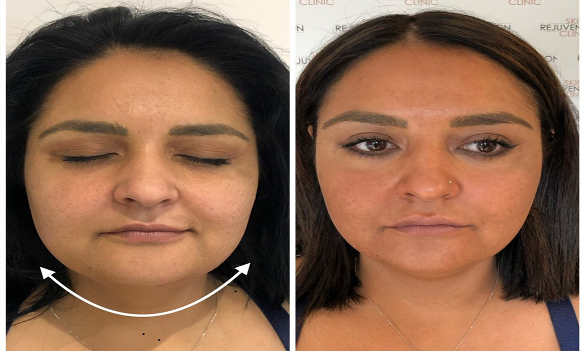 Skin Tightening Results