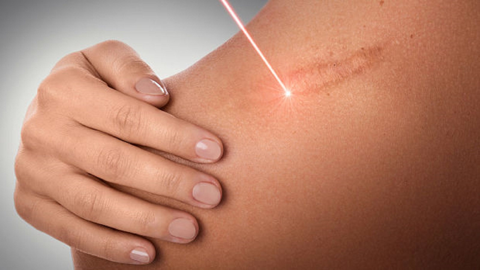 Cryotherapy for Keloids and Hypertrophic Scars