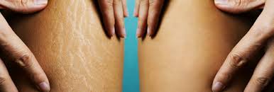 Stretch Marks Treatment