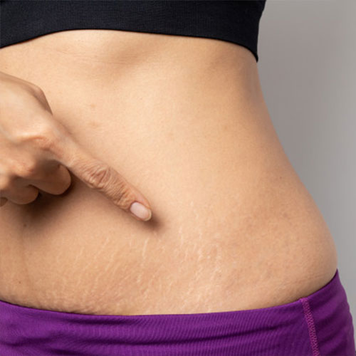 Before and after stretch mark treatment