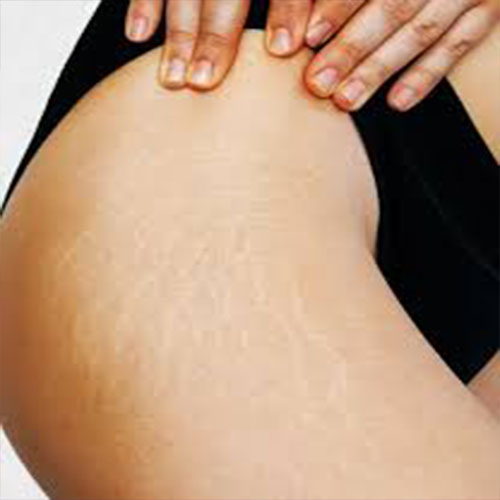 Laser treatment for stretch marks