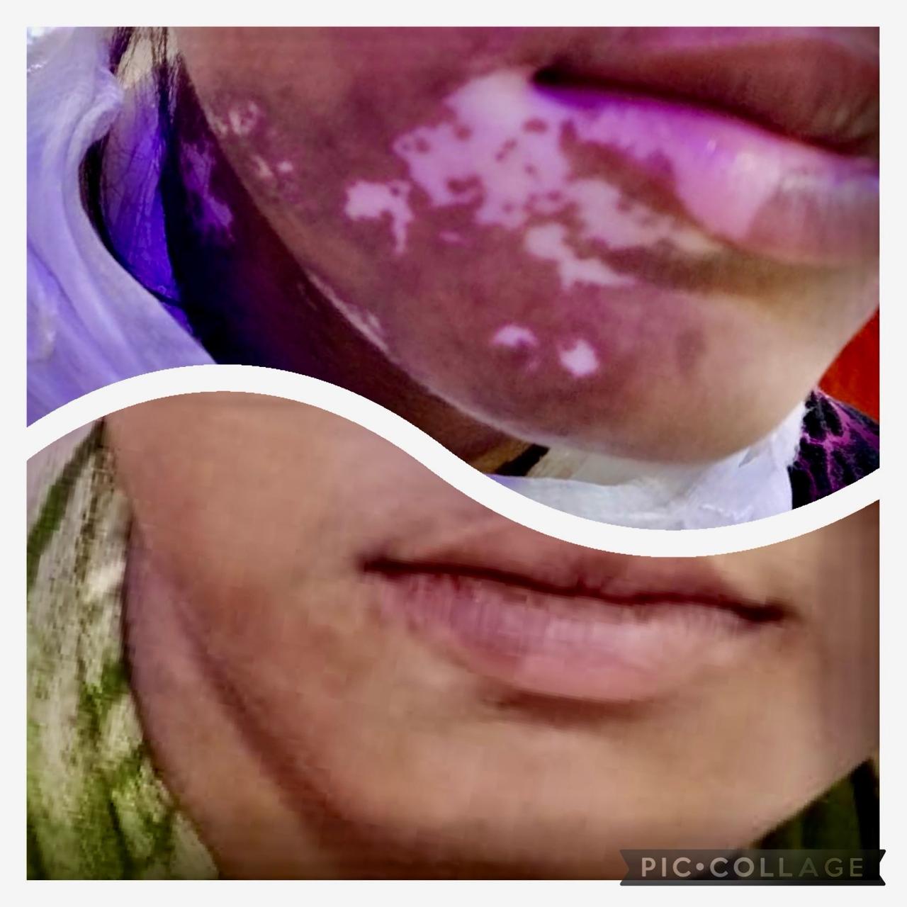Vitiligo Treatment Example