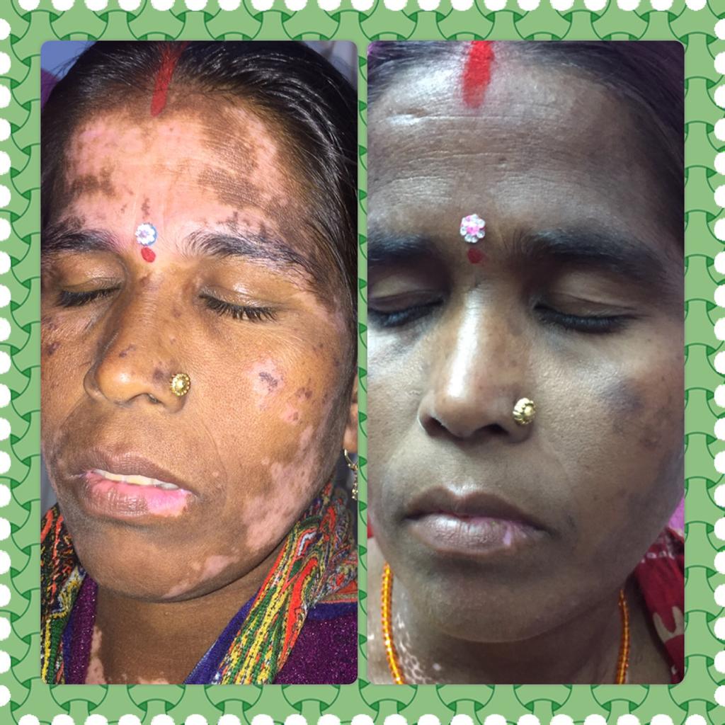 Before and After Grafting