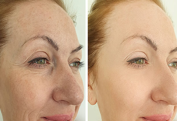 Before After Peeling