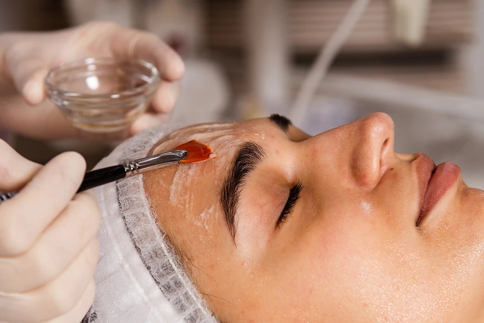 Chemical Peeling for Acne and Melasma