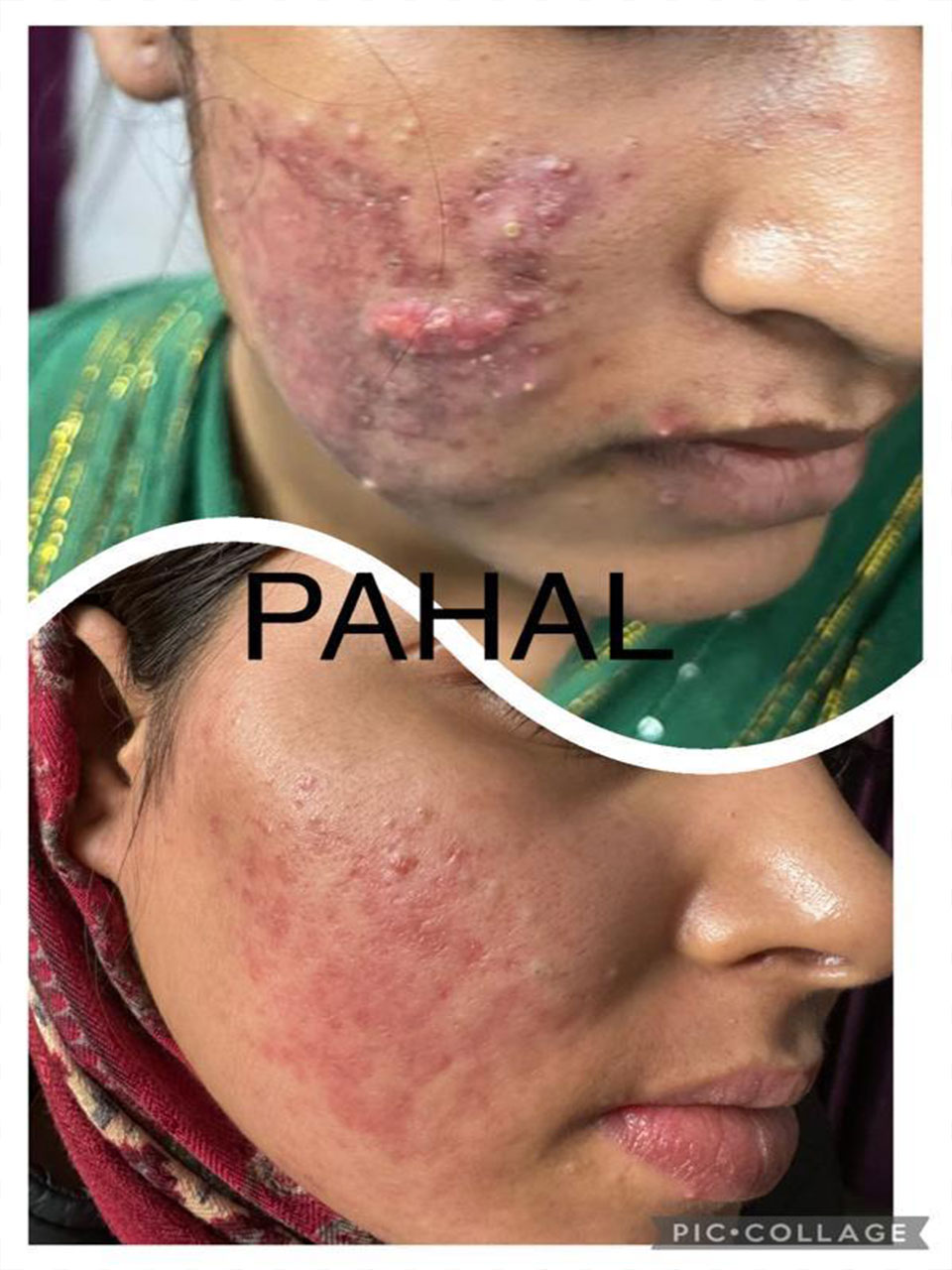 Before After Microdermabrasion