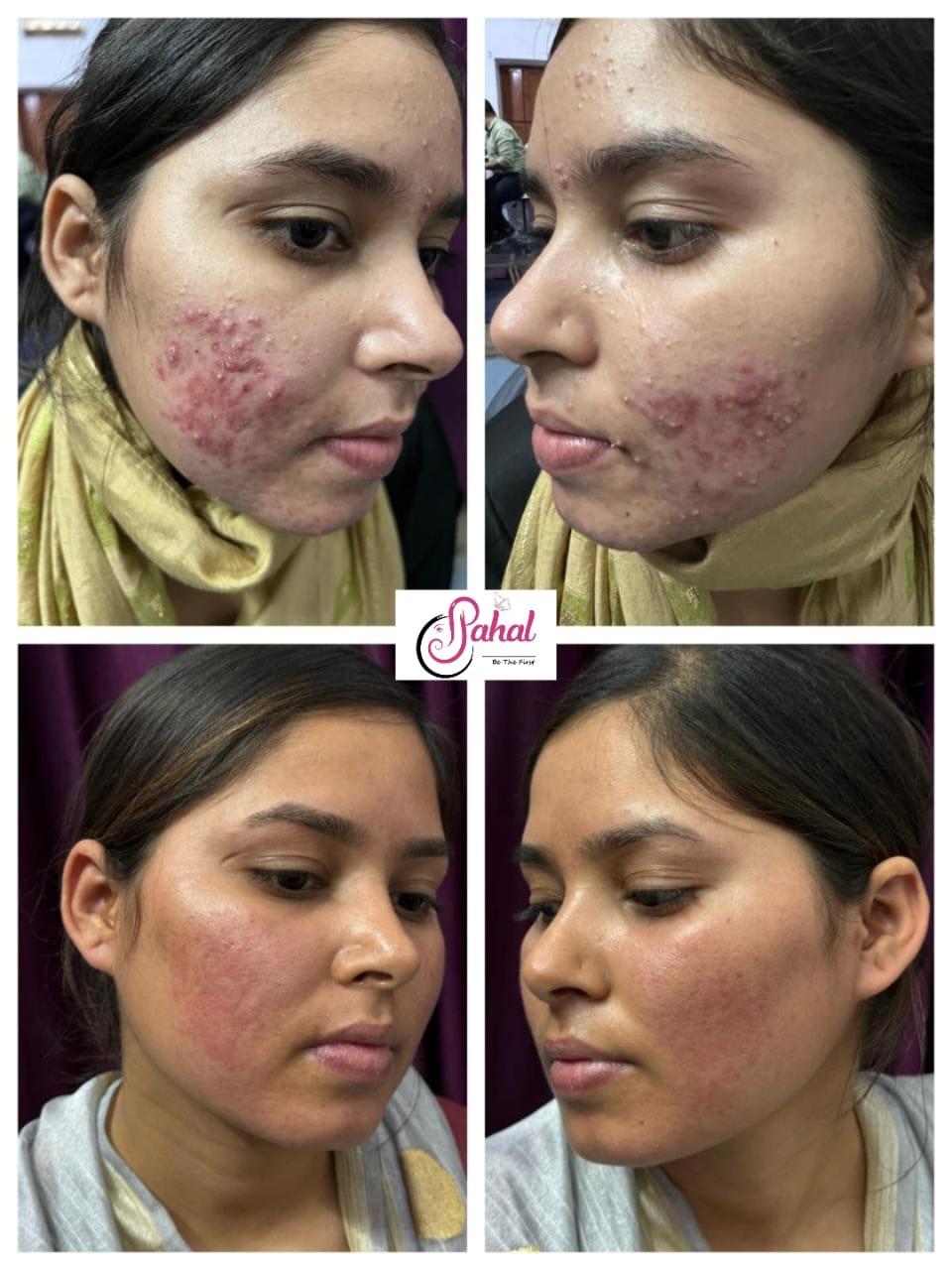 Glowing Skin After Treatment