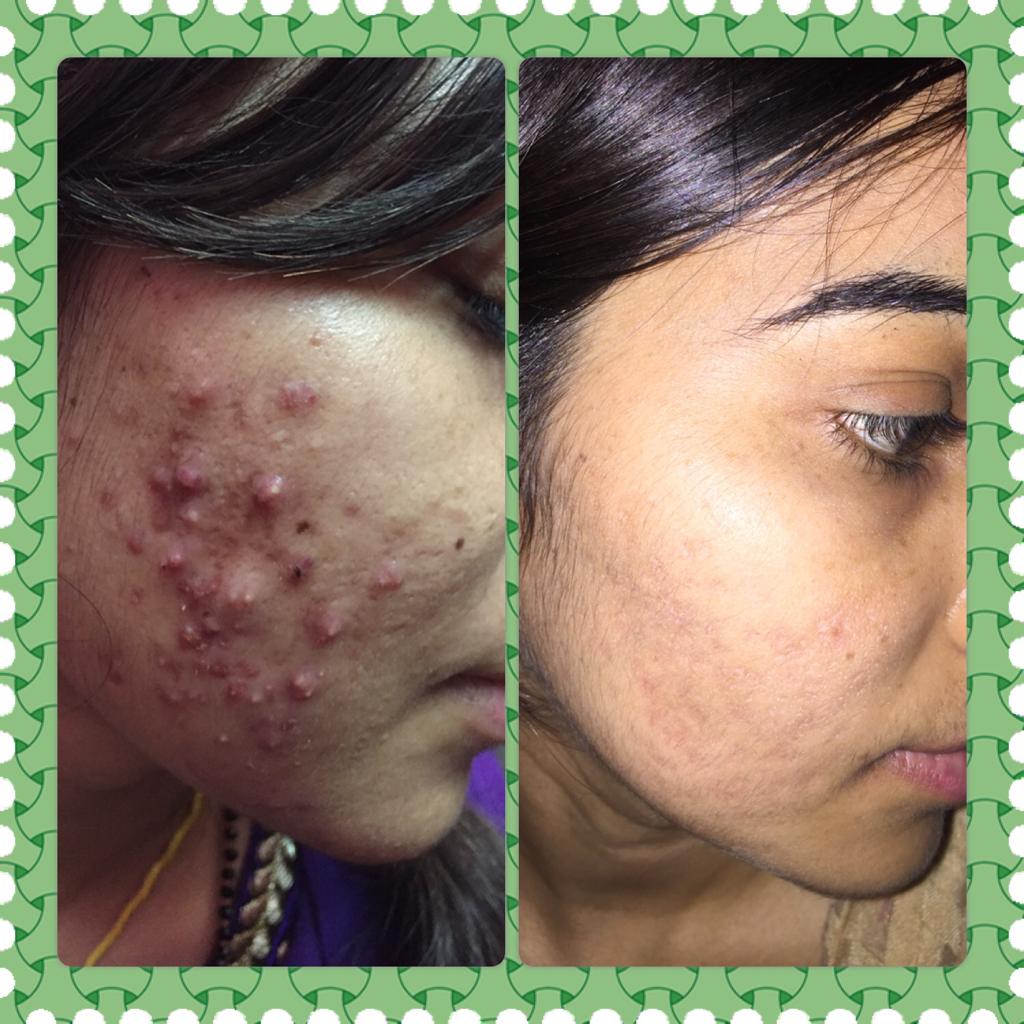 Microdermabrasion for Acne Scars