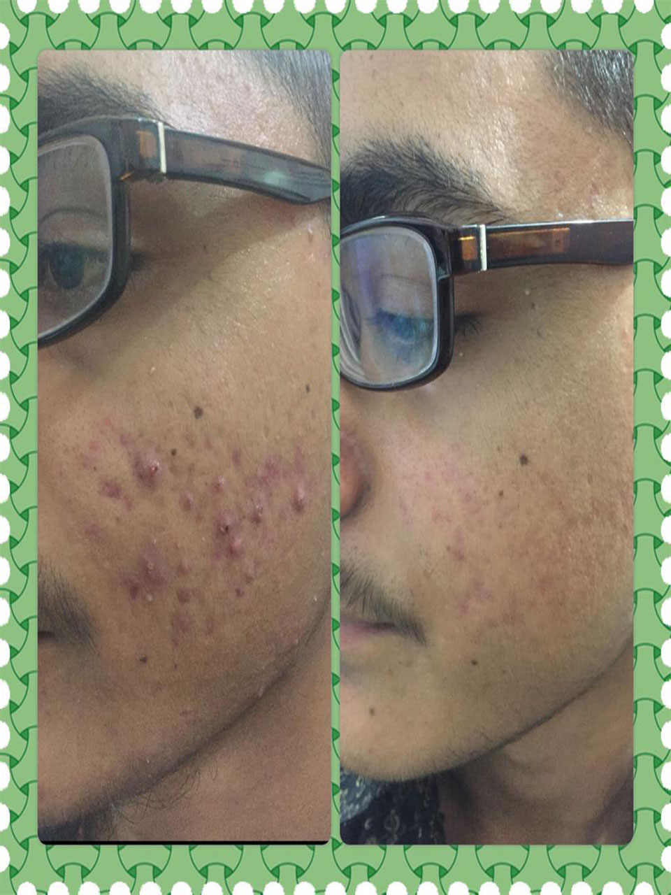 Microdermabrasion Treatment Process