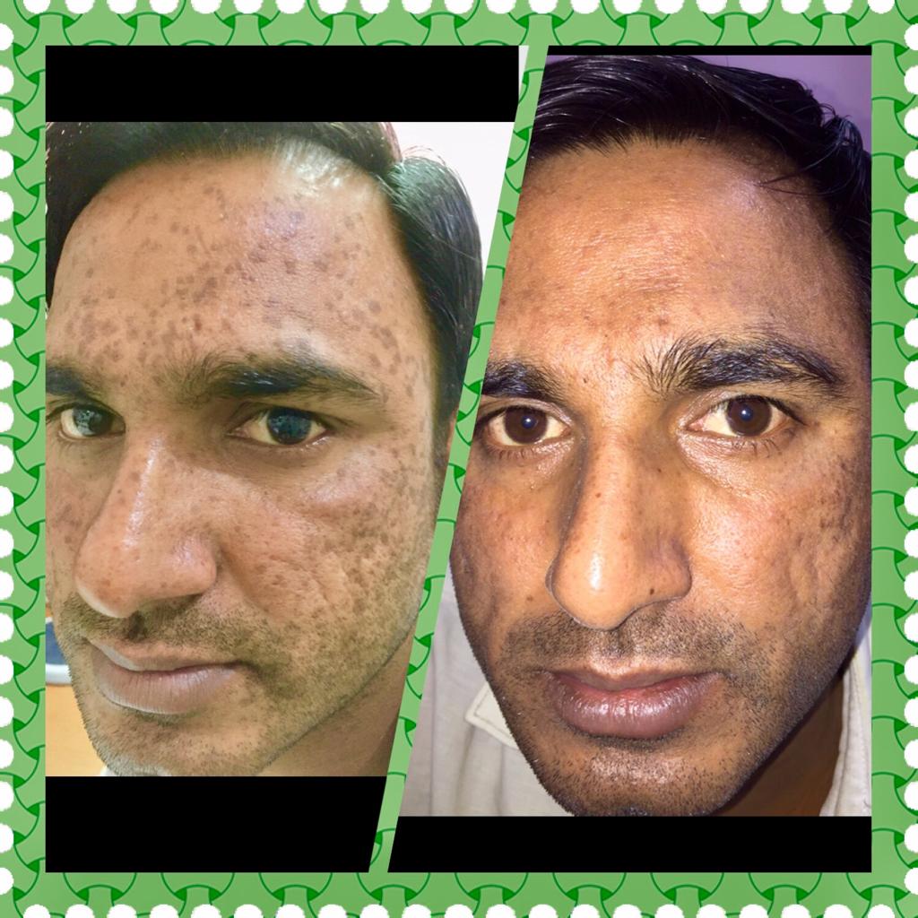 Hyperpigmentation Treatment