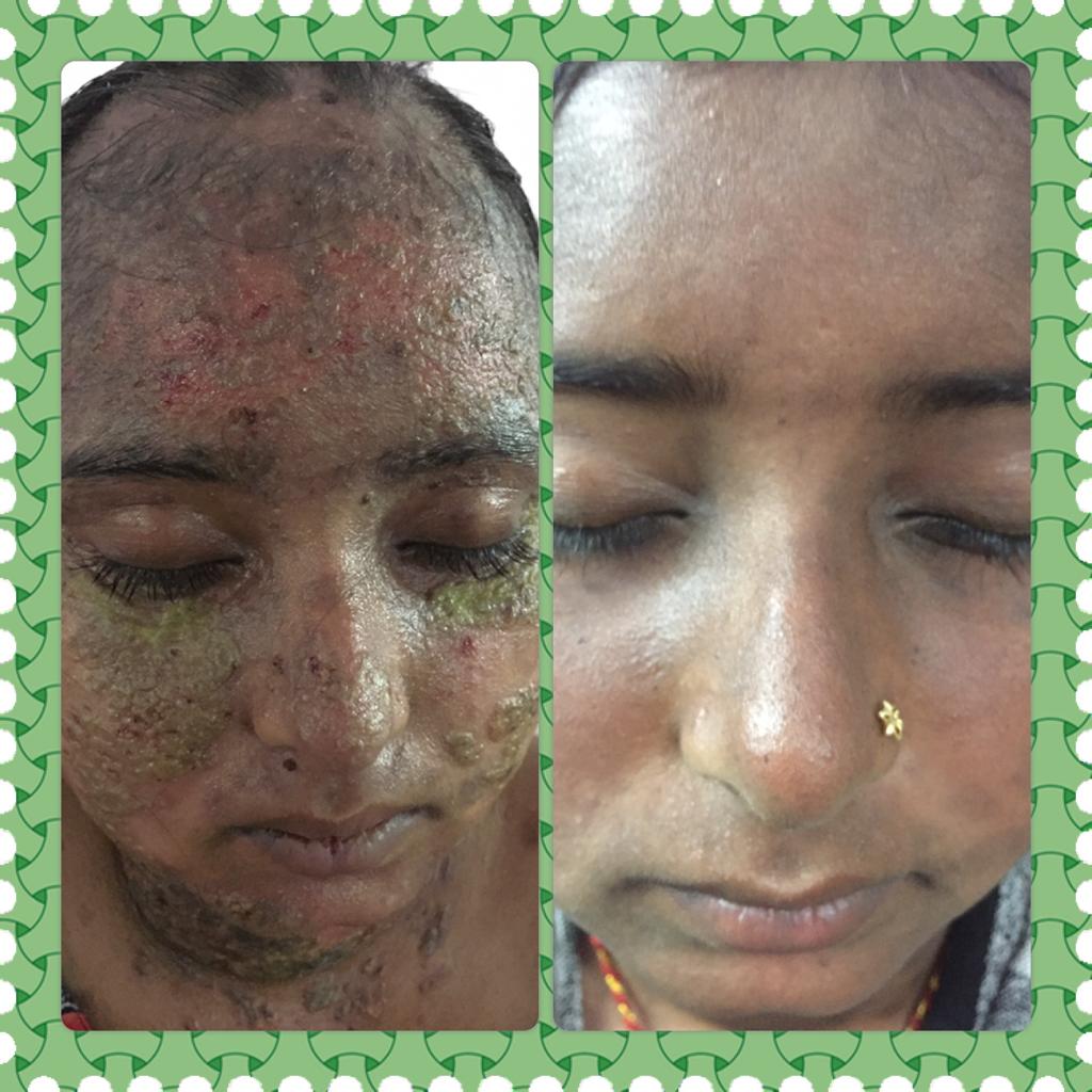 Laser Pigmentation Removal