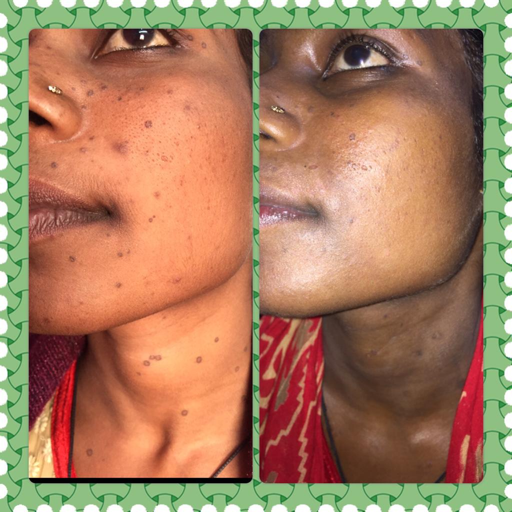 Pigmentation Treatment