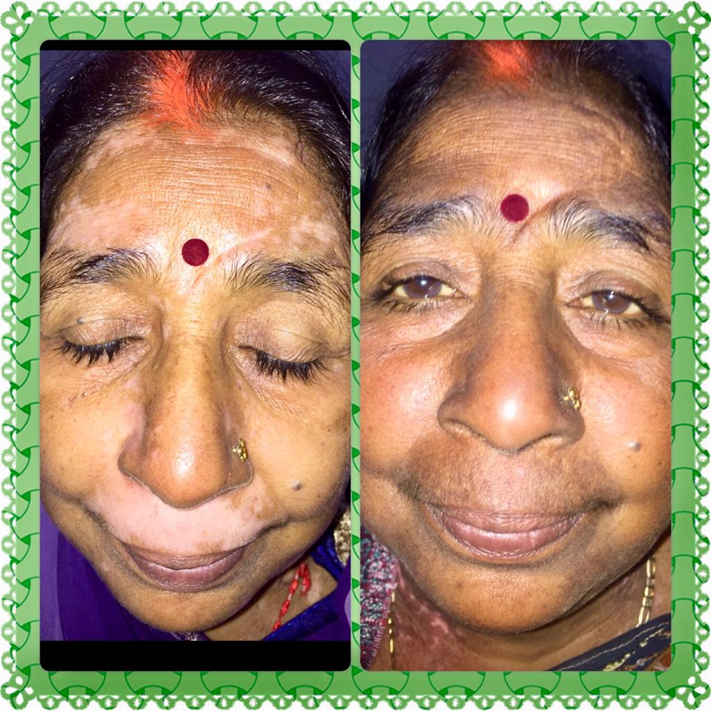 Skin Grafting for Vitiligo