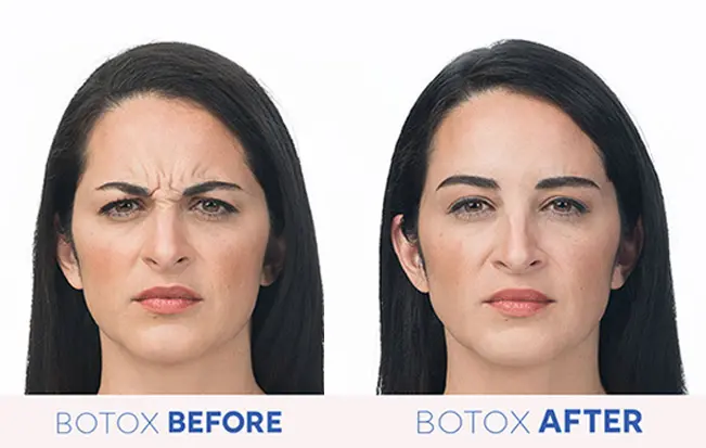 Before Botox Treatment